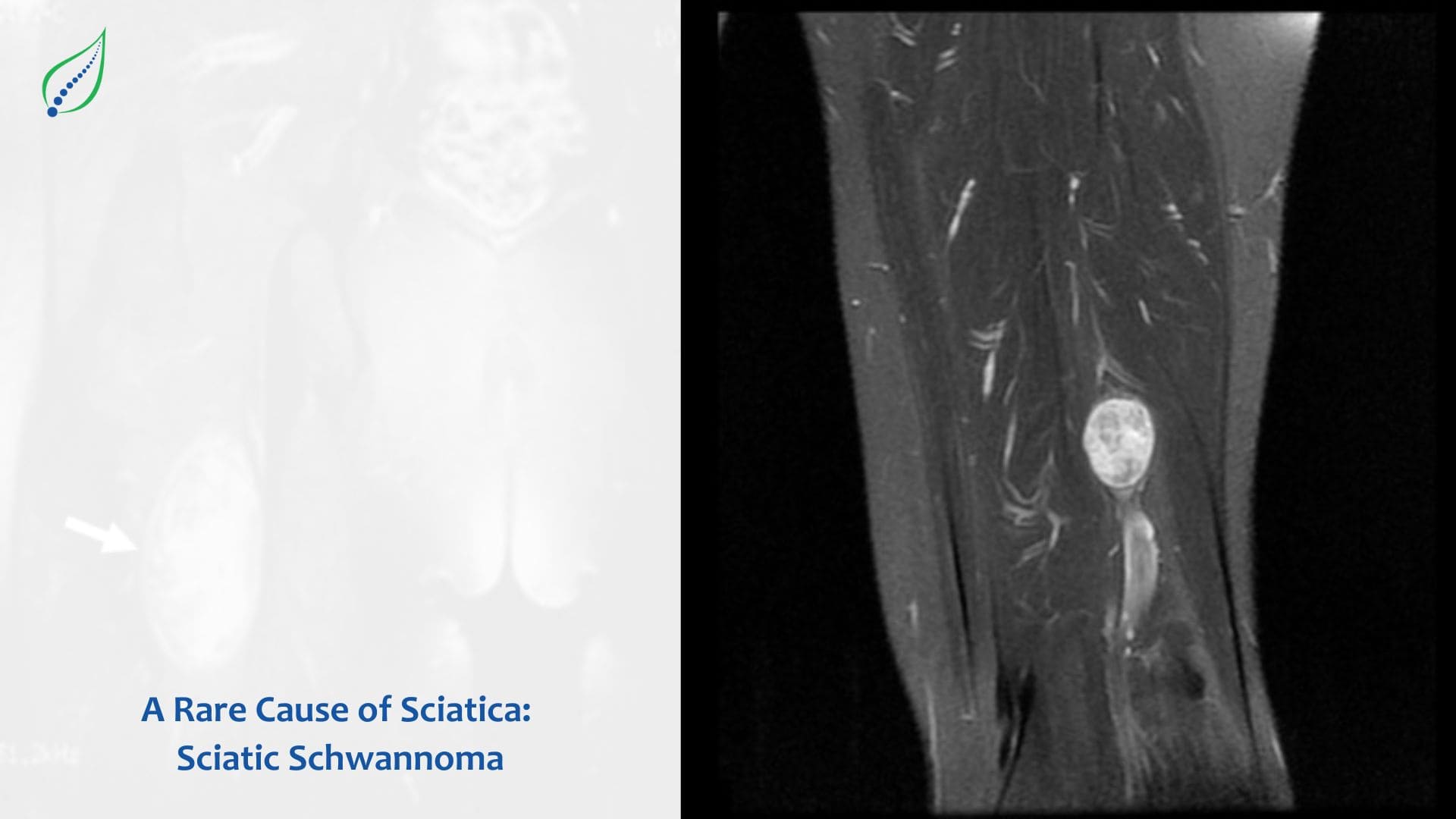 A Rare Cause of Sciatica: Sciatic Schwannoma
